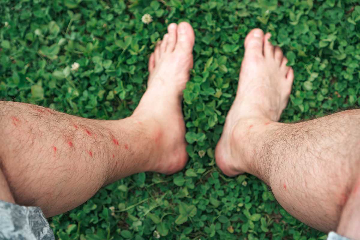 Two bare legs and feet with multiple red ant bite marks are seen against a background of green grass and clover. 