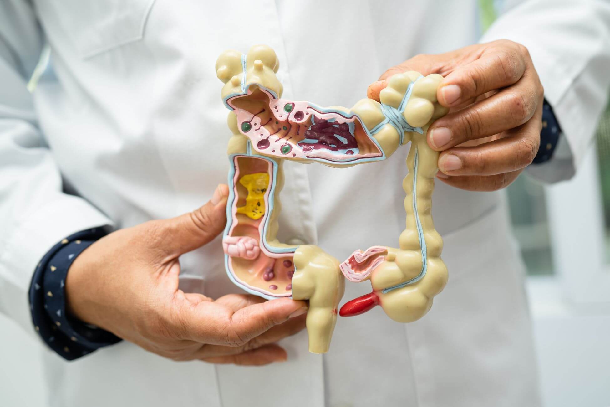 A person in a white lab coat holds a detailed anatomical model of the human colon, displaying healthy and unhealthy tissue sections.
